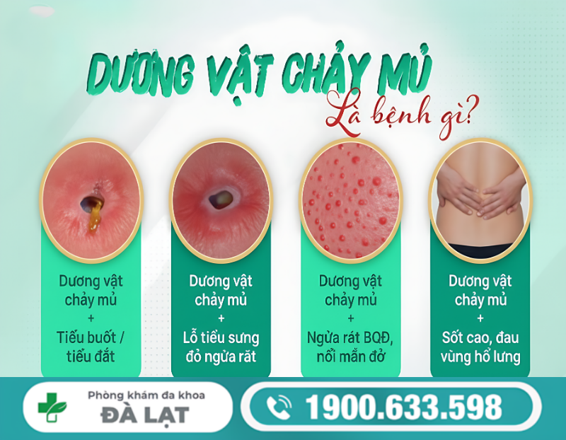 TÌM HIỂU VỀ DƯƠNG VẬT CHẢY DỊCH TRẮNG Ở NAM GIỚI